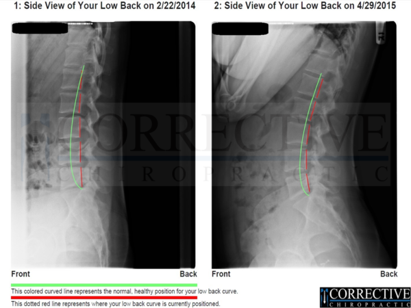 Corrective Chiropractic X-Ray Results