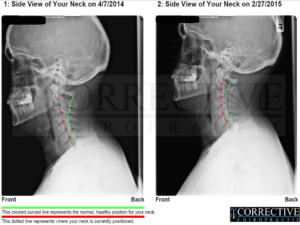 Corrective Chiropractic X-Ray Results